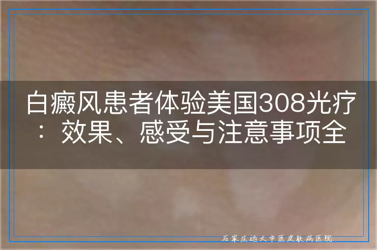 白癜风患者体验美国308光疗：效果、感受与注意事项全览