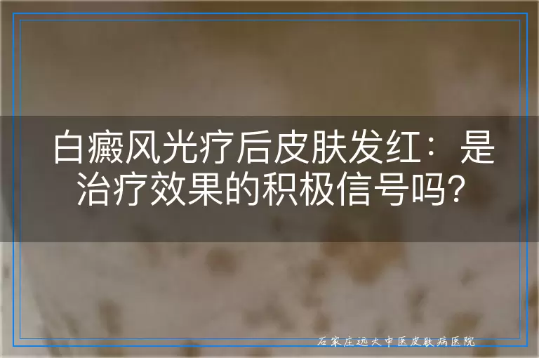 白癜风光疗后皮肤发红：是治疗效果的积极信号吗？