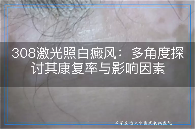 308激光照白癜风：多角度探讨其康复率与影响因素
