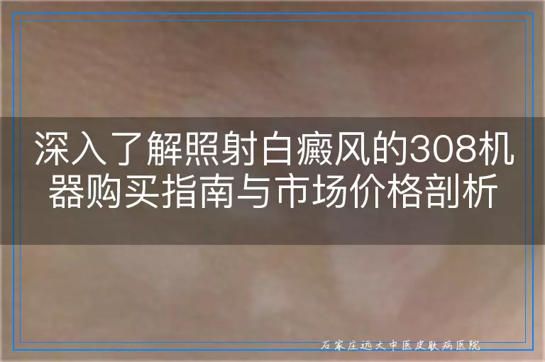 深入了解照射白癜风的308机器购买指南与市场价格剖析