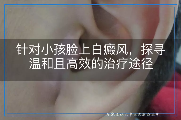 针对小孩脸上白癜风，探寻温和且高效的治疗途径