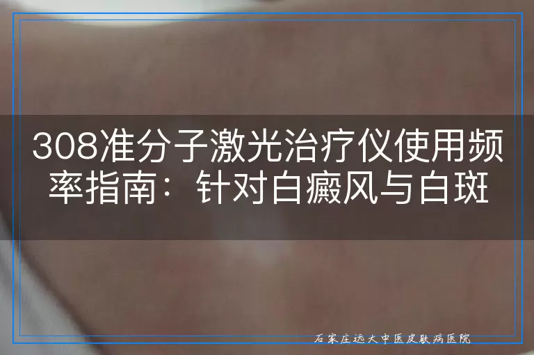 308准分子激光治疗仪使用频率指南：针对白癜风与白斑治疗的最优间隔探讨