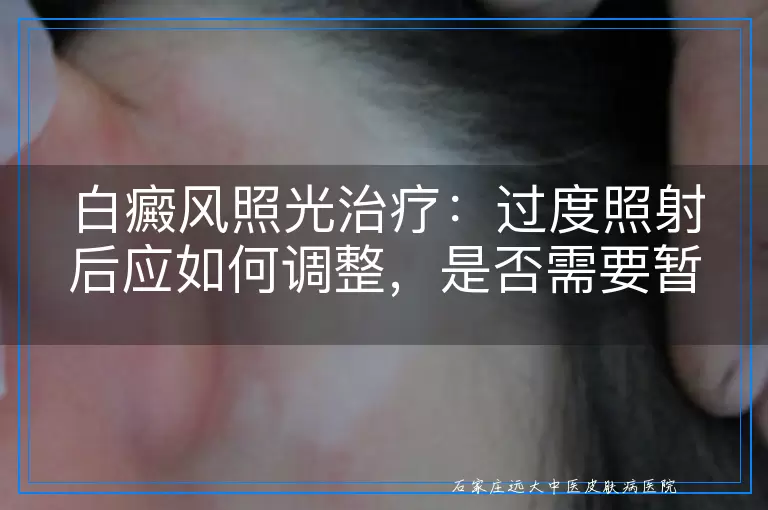 白癜风照光治疗：过度照射后应如何调整，是否需要暂停？