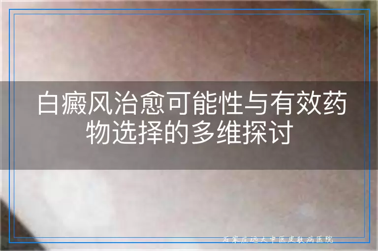 白癜风治愈可能性与有效药物选择的多维探讨
