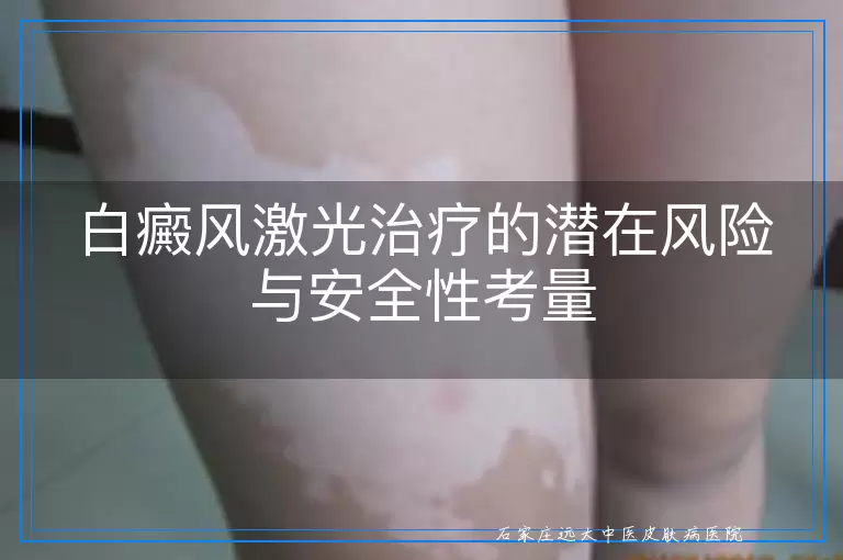 白癜风激光治疗的潜在风险与安全性考量