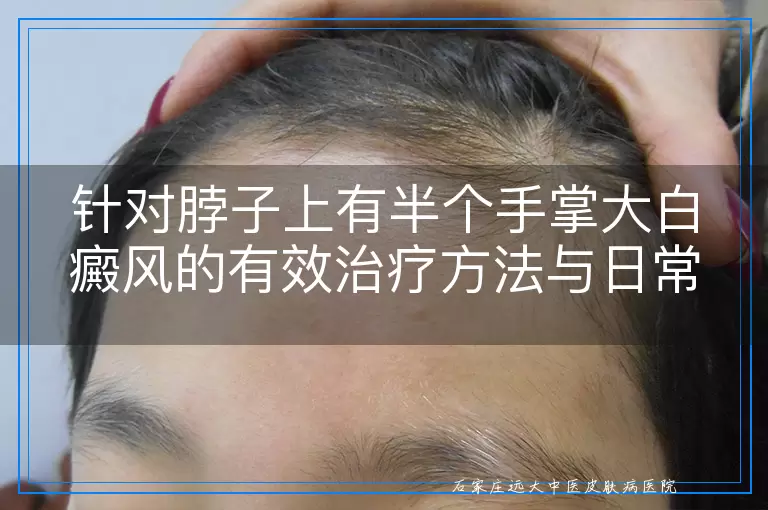 针对脖子上有半个手掌大白癜风的有效治疗方法与日常护理建议