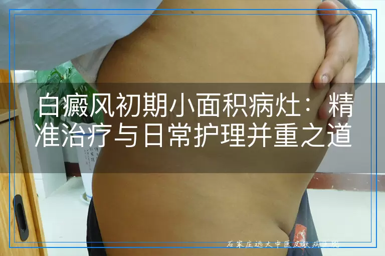 白癜风初期小面积病灶：精准治疗与日常护理并重之道