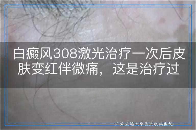 白癜风308激光治疗一次后皮肤变红伴微痛，这是治疗过程中的正常现象吗？