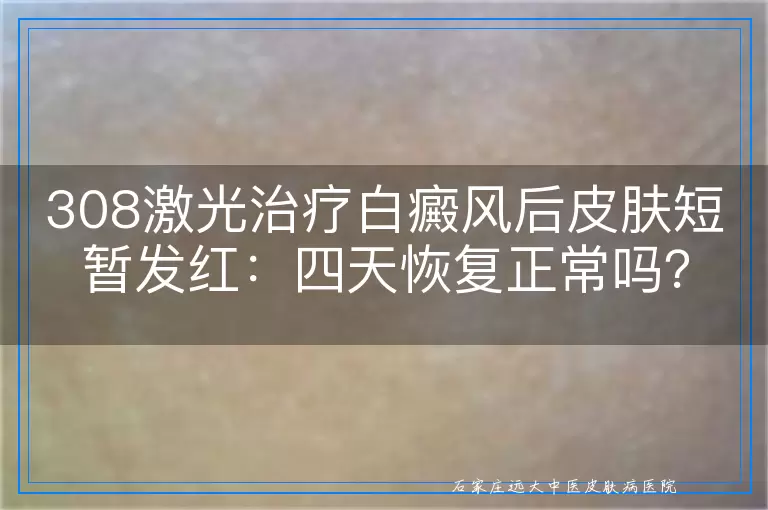 308激光治疗白癜风后皮肤短暂发红：四天恢复正常吗？