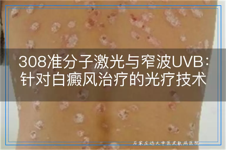 308准分子激光与窄波UVB：针对白癜风治疗的光疗技术深度透视