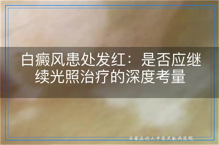 白癜风患处发红：是否应继续光照治疗的深度考量