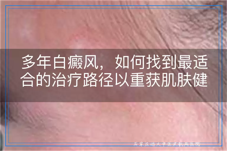 多年白癜风，如何找到最适合的治疗路径以重获肌肤健康？