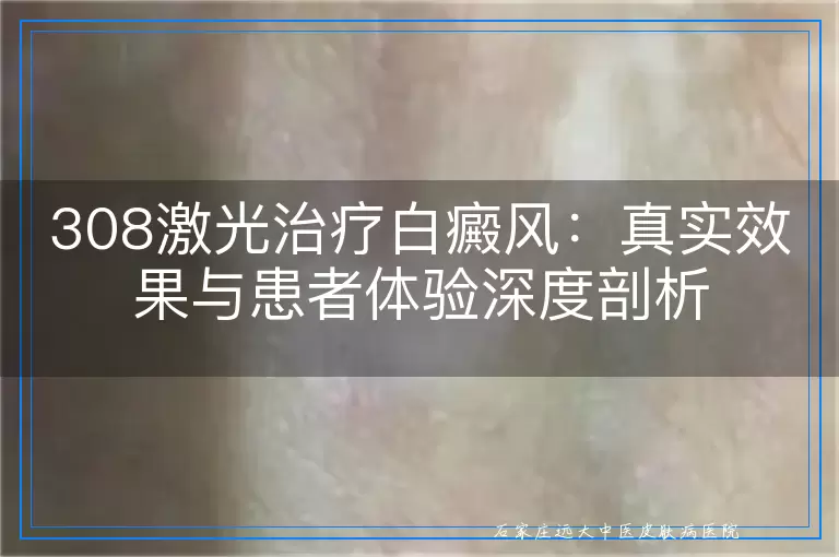 308激光治疗白癜风：真实效果与患者体验深度剖析