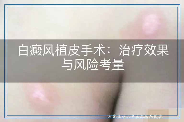 白癜风植皮手术：治疗效果与风险考量
