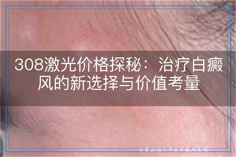 308激光价格探秘：治疗白癜风的新选择与价值考量
