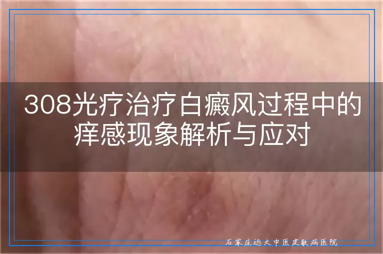 308光疗治疗白癜风过程中的痒感现象解析与应对