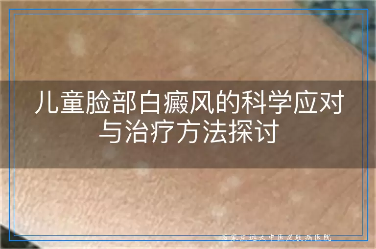 儿童脸部白癜风的科学应对与治疗方法探讨