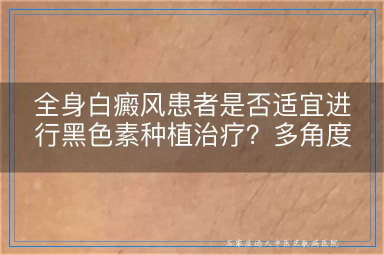 全身白癜风患者是否适宜进行黑色素种植治疗？多角度探讨其适用性
