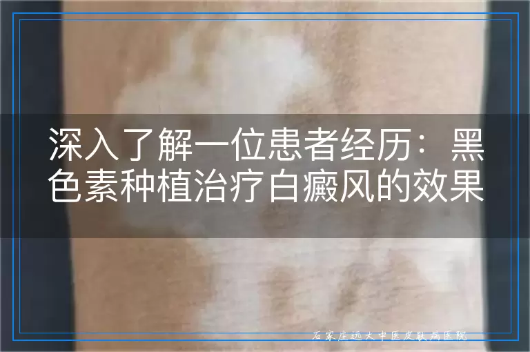 深入了解一位患者经历：黑色素种植治疗白癜风的效果与心路历程
