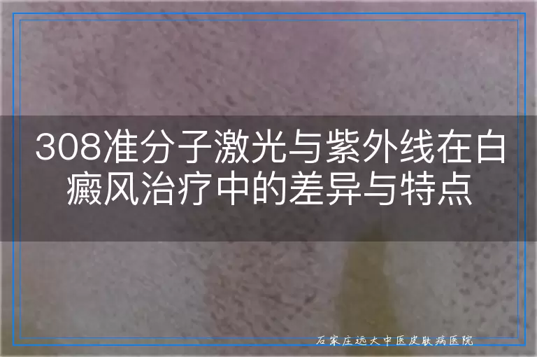 308准分子激光与紫外线在白癜风治疗中的差异与特点