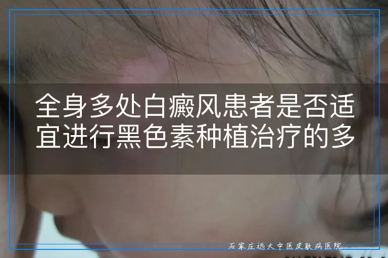 全身多处白癜风患者是否适宜进行黑色素种植治疗的多维度考量