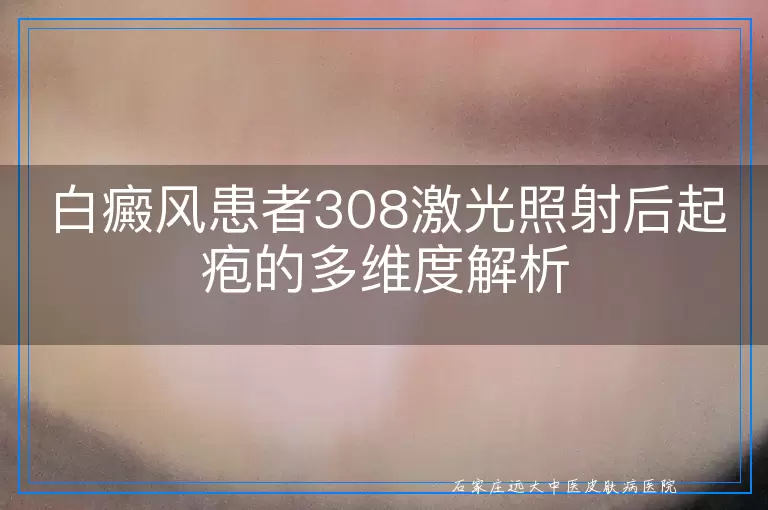 白癜风患者308激光照射后起疱的多维度解析