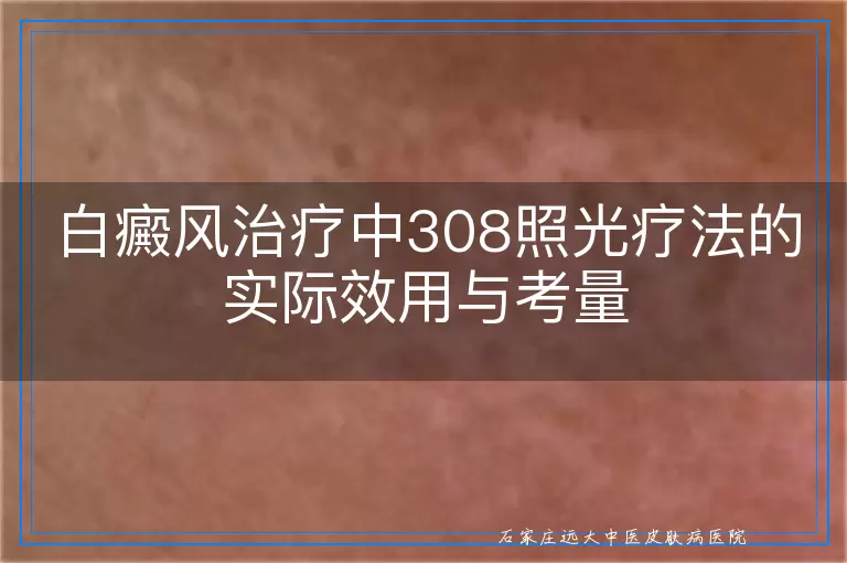 白癜风治疗中308照光疗法的实际效用与考量
