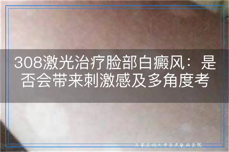 308激光治疗脸部白癜风：是否会带来刺激感及多角度考量