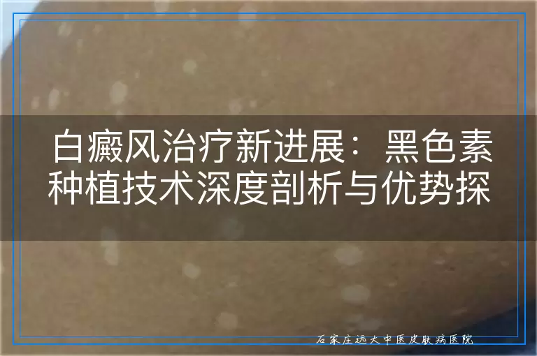 白癜风治疗新进展：黑色素种植技术深度剖析与优势探讨