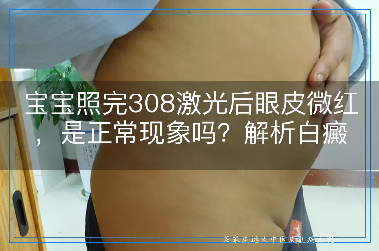 宝宝照完308激光后眼皮微红，是正常现象吗？解析白癜风治疗中的这一细微变化