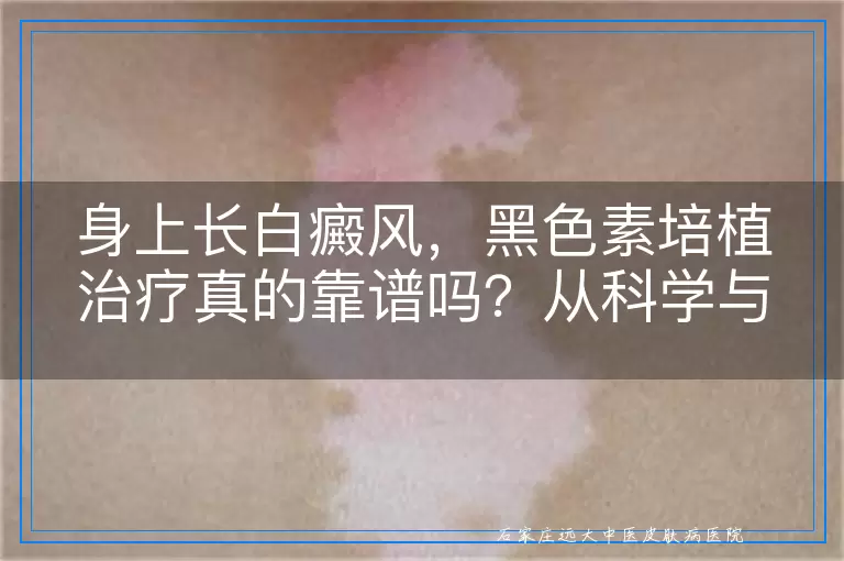 身上长白癜风，黑色素培植治疗真的靠谱吗？从科学与实践角度深度剖析