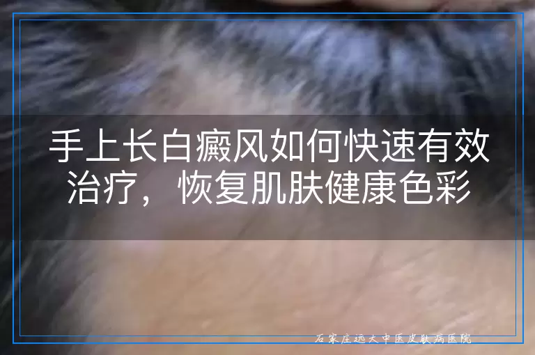 手上长白癜风如何快速有效治疗，恢复肌肤健康色彩