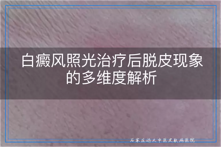白癜风照光治疗后脱皮现象的多维度解析