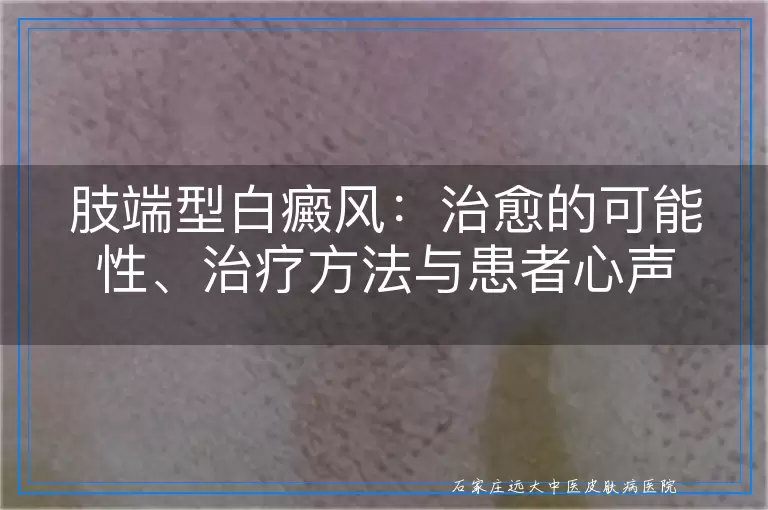 肢端型白癜风：治愈的可能性、治疗方法与患者心声