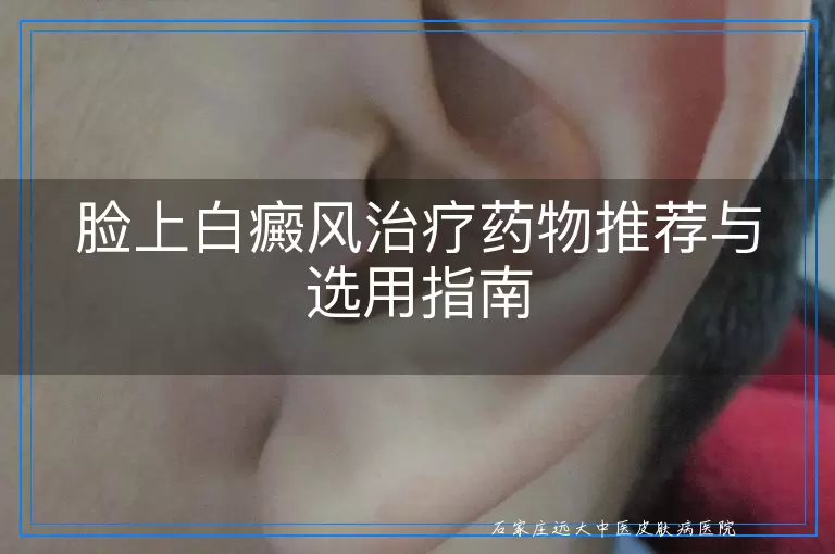 脸上白癜风治疗药物推荐与选用指南