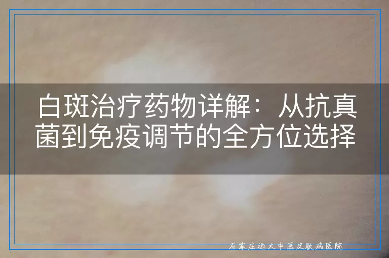 白斑治疗药物详解：从抗真菌到免疫调节的全方位选择