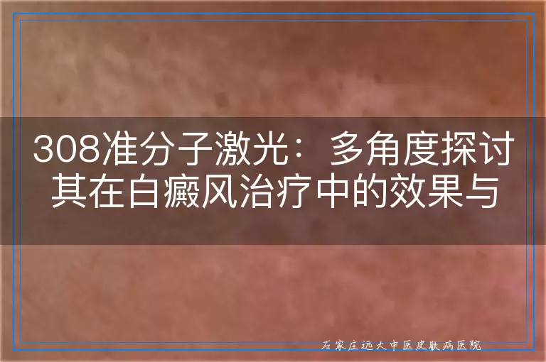 308准分子激光：多角度探讨其在白癜风治疗中的效果与适用性