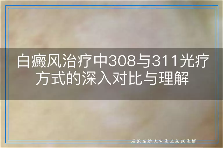 白癜风治疗中308与311光疗方式的深入对比与理解