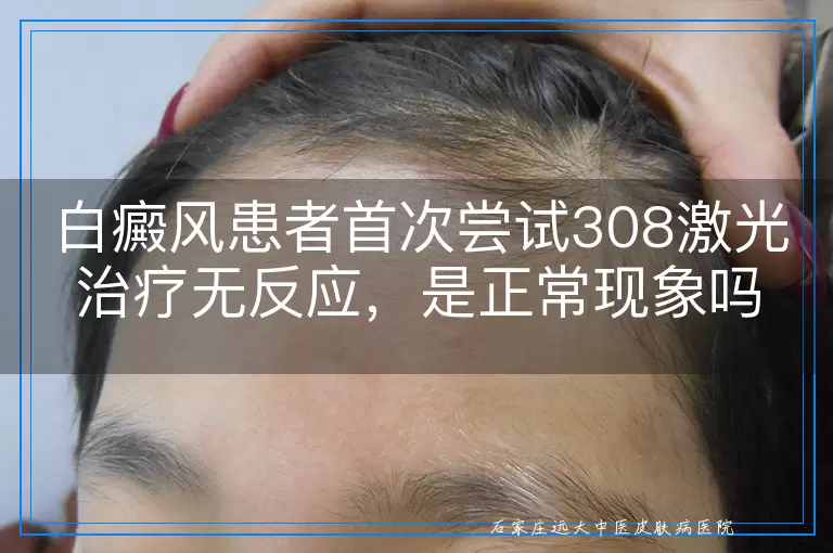 白癜风患者首次尝试308激光治疗无反应，是正常现象吗？