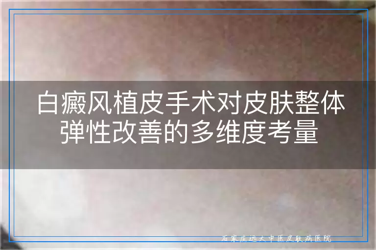 白癜风植皮手术对皮肤整体弹性改善的多维度考量