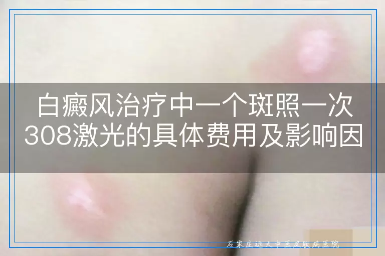 白癜风治疗中一个斑照一次308激光的具体费用及影响因素
