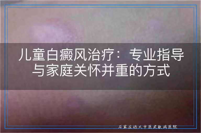 儿童白癜风治疗：专业指导与家庭关怀并重的方式