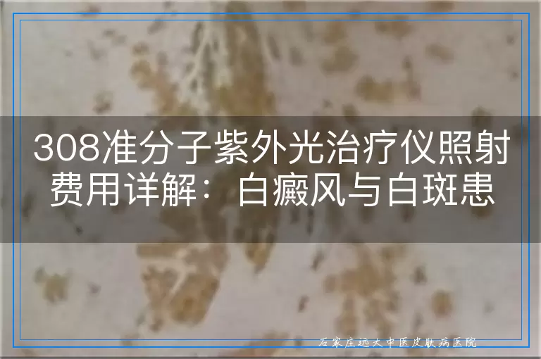 308准分子紫外光治疗仪照射费用详解：白癜风与白斑患者的治疗成本