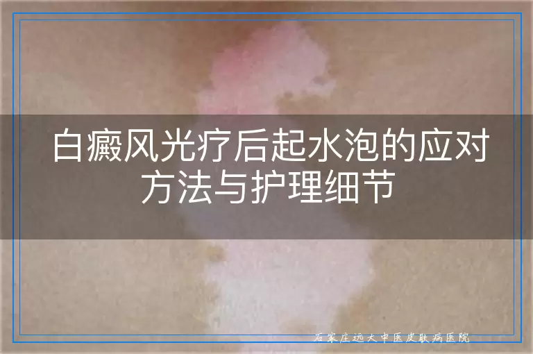 白癜风光疗后起水泡的应对方法与护理细节