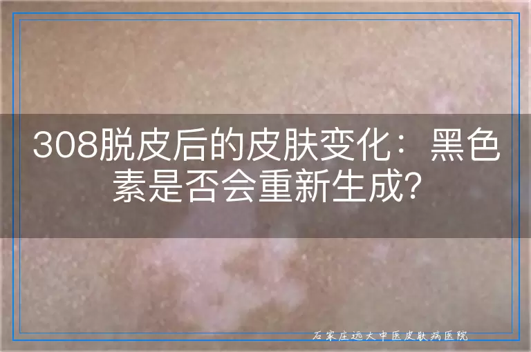 308脱皮后的皮肤变化：黑色素是否会重新生成？
