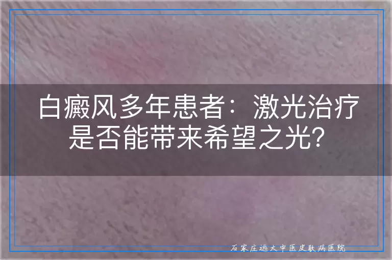 白癜风多年患者：激光治疗是否能带来希望之光？