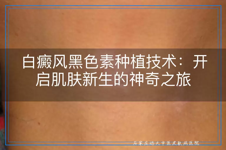 白癜风黑色素种植技术：开启肌肤新生的神奇之旅