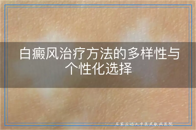 白癜风治疗方法的多样性与个性化选择