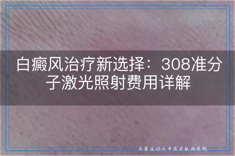 白癜风治疗新选择：308准分子激光照射费用详解