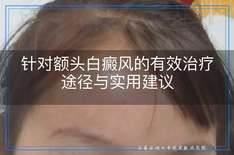 针对额头白癜风的有效治疗途径与实用建议